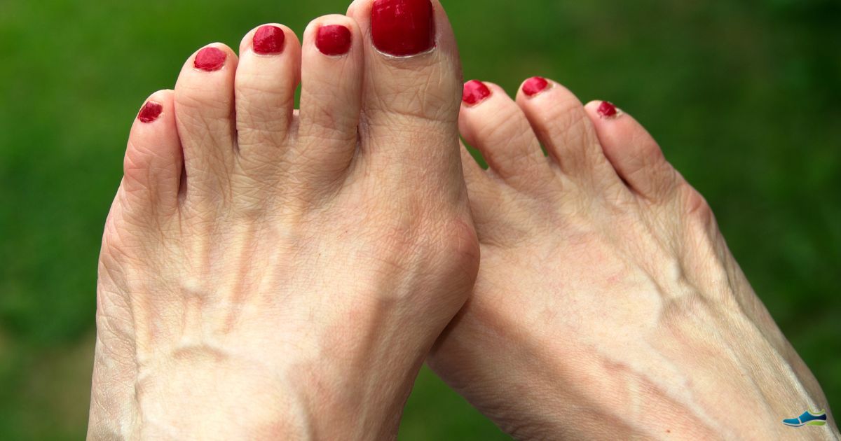 a bunion on the foot