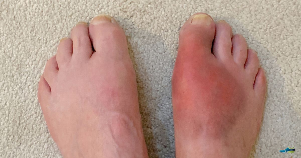 Right foot very red, affected by gout - fast pain relief from gout